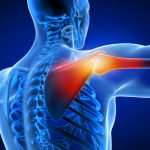 Shoulder fracture
